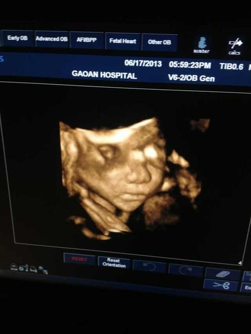 宝宝24周的四维彩超照片