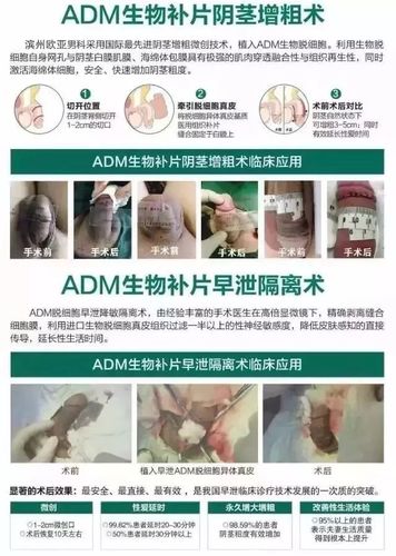 革命性技术一,adm脱细胞生物补片早泄隔离术
