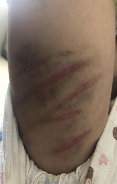 10岁女童疑遭家暴全身数十道血痕 官方已介入
