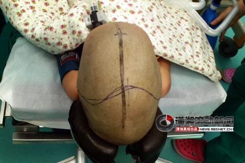 3岁幼儿患上狭颅症术后已康复图