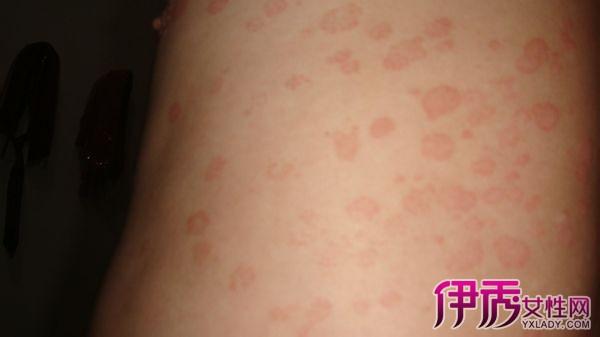 红斑狼疮早期症状图片 教你如何治疗红斑狼疮