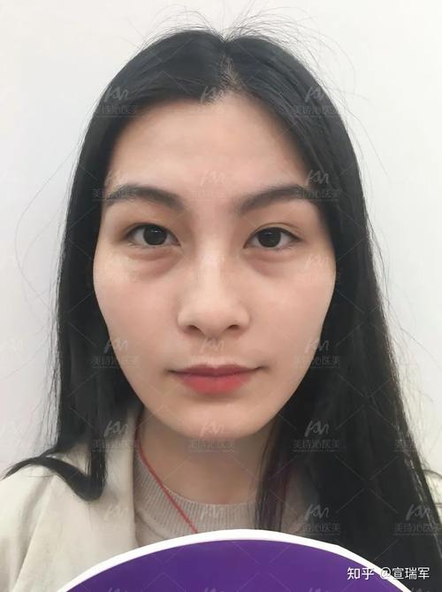 2,眼袋型泪沟:对于眼袋型泪沟,以往大家只把注意力放在眼袋而忽略了