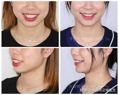 有没有牙齿很整齐咬合也正常单纯因为嘴凸去矫正牙齿的小伙伴?