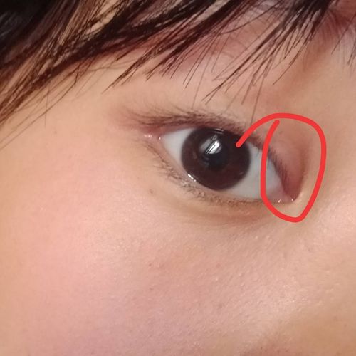 右眼的眼皮上有了一个类似于水泡的东西.