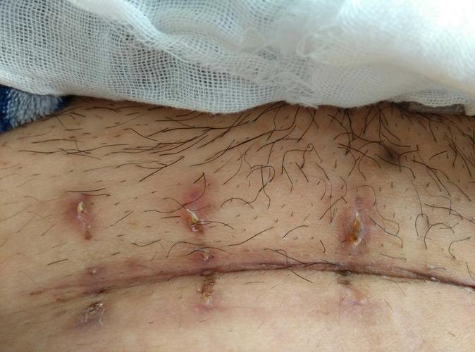 剖腹产23天,刀口正常吗?