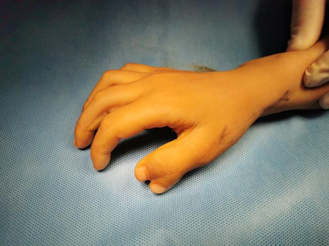 多指并指的手术治疗