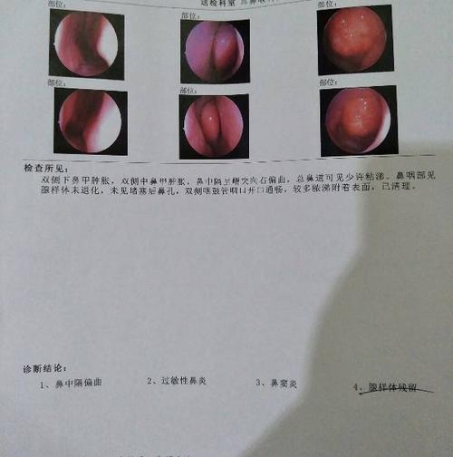 鼻窦炎 鼻中隔偏曲 鼻甲肥大 有没有在线医生,你们的医院的手术费用是