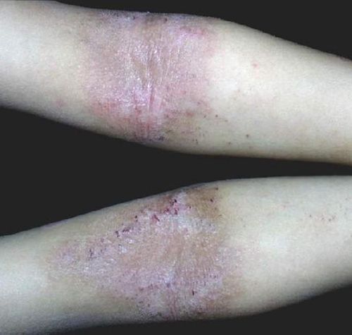 异位性皮炎的图片