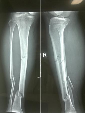 胫腓骨粉碎性骨折并伴有腓总神经损伤,胫骨用髓内钉固定,腓骨用钢板