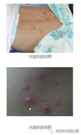 "水痘"高发期将至,请注意预防