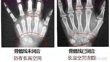 青春期发育之后,骨骺线就会逐渐闭合,长骨不再生长,四肢不再变长,也