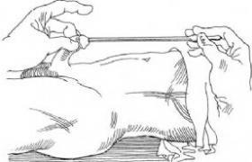 狭窄扩张术 首页 共收录 7197 个手术 男性尿道狭窄是泌尿外科常见病