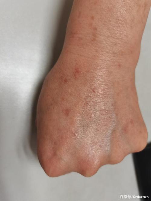 扁平疣和脂溢性角化病的鉴别诊断