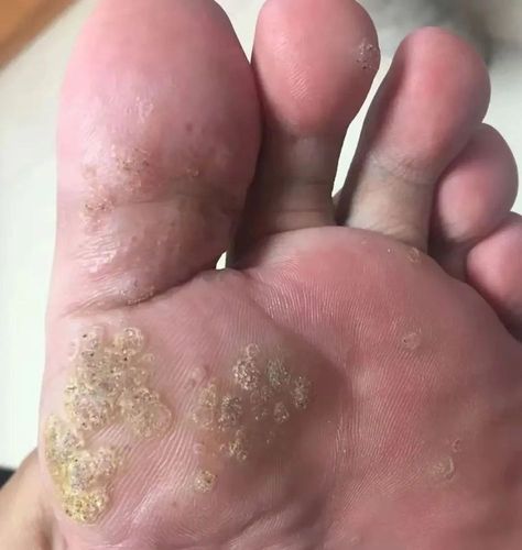 福州一25岁男孩脚上莫名其妙长了一大片水泡,医生惊呆