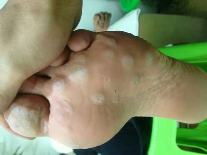 主治: 灰指甲 甲沟炎 血胞刺 鸡眼 肉刺 手足癣 脚汗臭 脚脱皮开裂