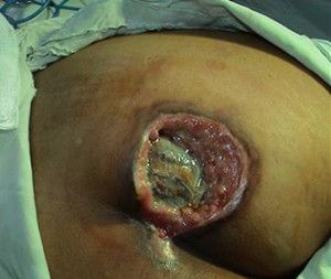 不及时治疗褥疮溃烂创面会对患者身体带来哪些危害呢?