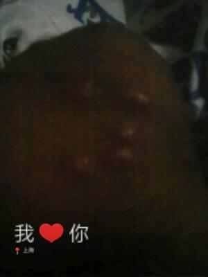 阴囊上有小疙瘩?