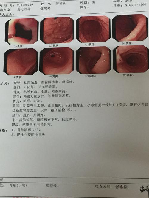 之前得了胃炎,大便不出,去做了胃镜,显示胃溃疡(h2),浅表