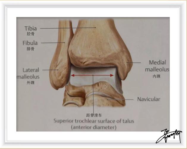 反复崴脚,也会导致踝关节距骨软骨损伤喔!