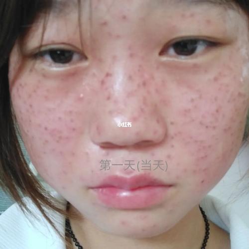 药水点斑(有图慎入!)_护肤_美妆_美妆_护肤_护肤其他