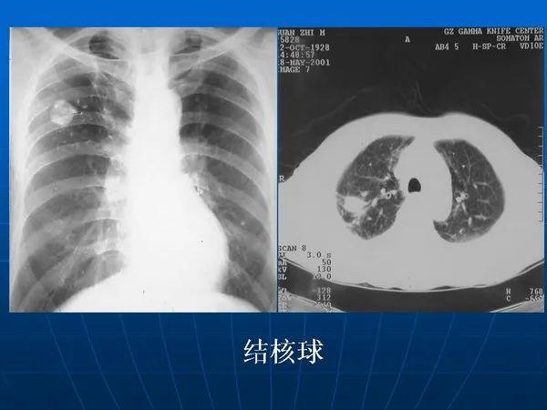 各型肺结核的典型影像表现