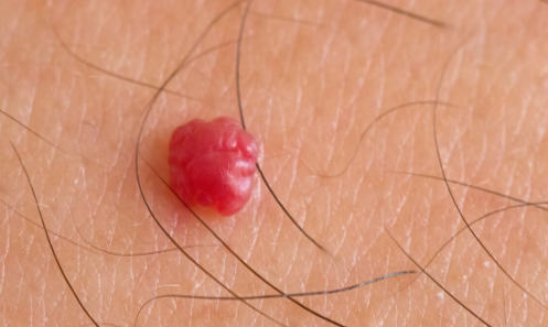 女性感染hpv病毒,初期的症状不太明显,会出现一些红色的小点点,绝大