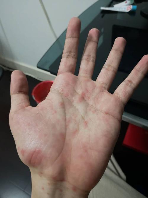 不痒,完全没感觉.本人以前得过牛皮癣,但是这次只有手上有,怎么回事