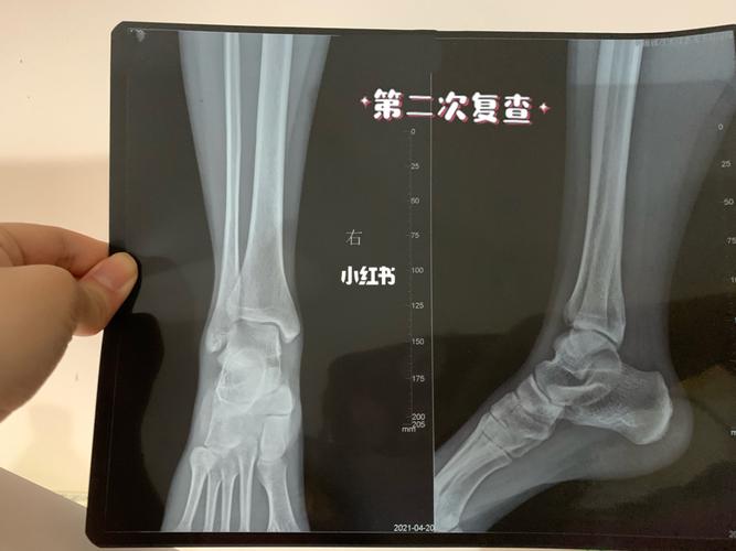 求助:大神看片子_骨折康复_医疗健康_医疗健康其他