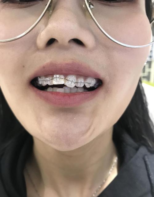 牙套需要带两年是什么体验,怕被人嫌弃?