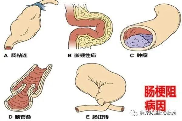 别小看肠梗阻严重时可致命