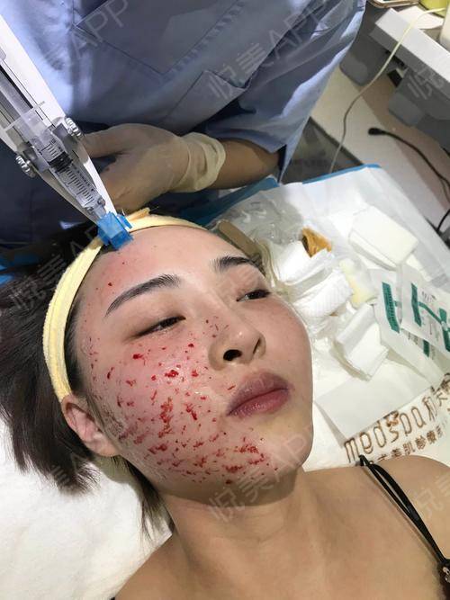 水光针手术当天_嫩肤手术当天_水光针手术当天_皮肤美容美妆手术当天