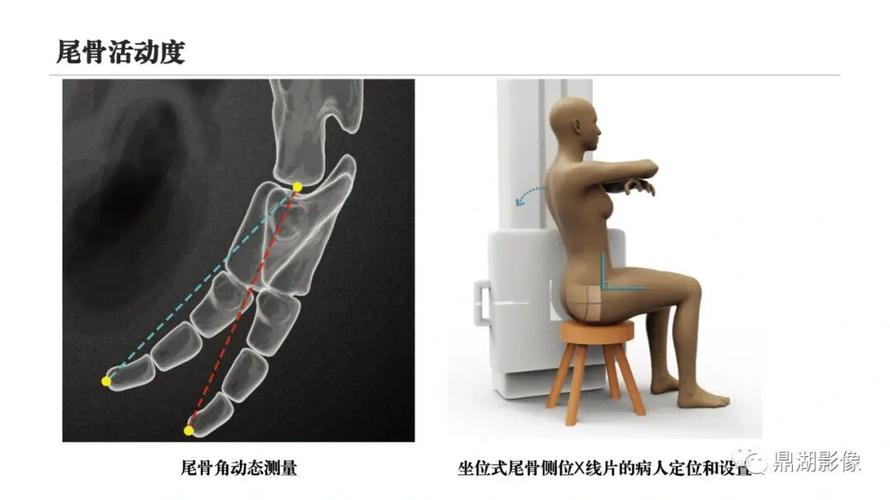尾骨_产后尾骨痛_医疗健康_医疗健康其他