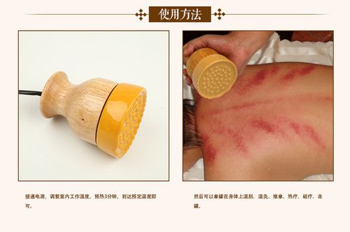 益阳天年 养扶阳罐温灸仪养生聚阳罐 艾灸仪器汉灸经络刮痧便携器械