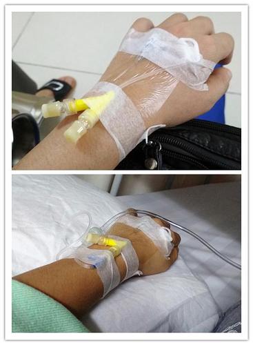 因为住院当天中午开始吊针,去了个厕所手就开始肿了,护士建议我