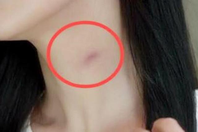 13岁女孩脖子上出现"草莓印",父母追问原因,女孩的话
