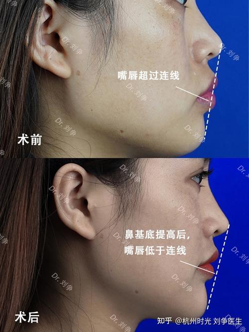 鼻基底凹陷面部会出现哪些特征