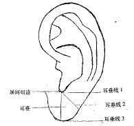 耳垂线与脑血管病关系的初步研究