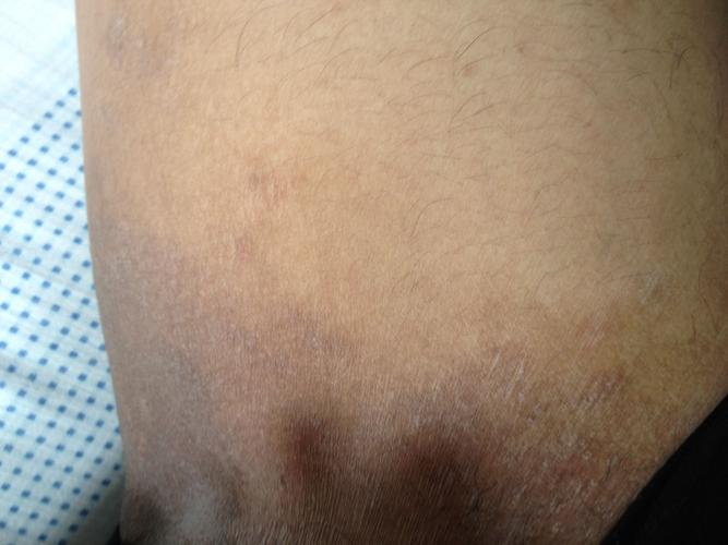 大腿俩侧经常痒抓后发现比别处要黑很多怎么办已经2年多了