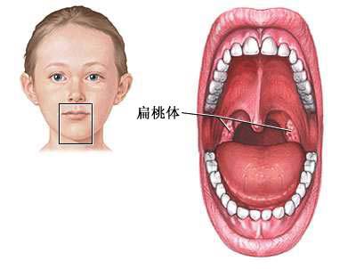 扁桃体炎