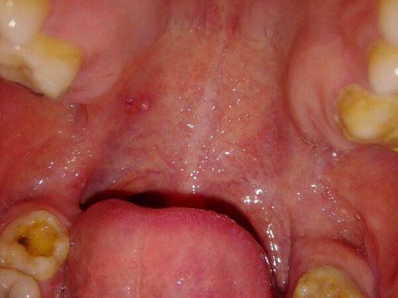 艾滋病引起的口腔症状