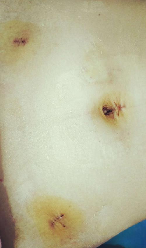 鹿楼医院宫外孕微创手术