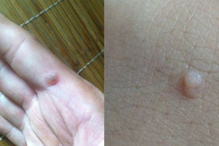 鱼鳞痣的治疗方法有哪些用这4大妙招好得快