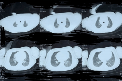 胸片提示少量气胸,幸亏坚持做了 ct,不然事情就糟了