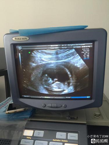 看见彩超上写着可见一胎儿雏形,把我逗乐了!