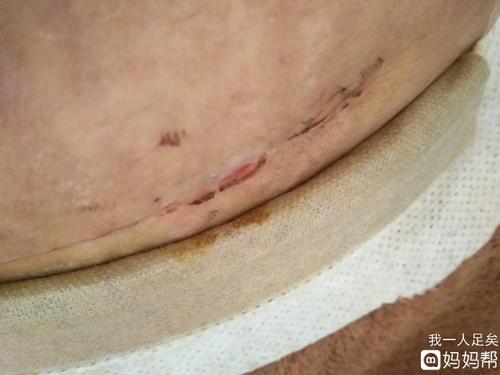 那个刨腹产的宝妈知道我这伤口是化脓了还是怎么了