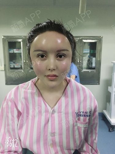 自体脂肪面部填充