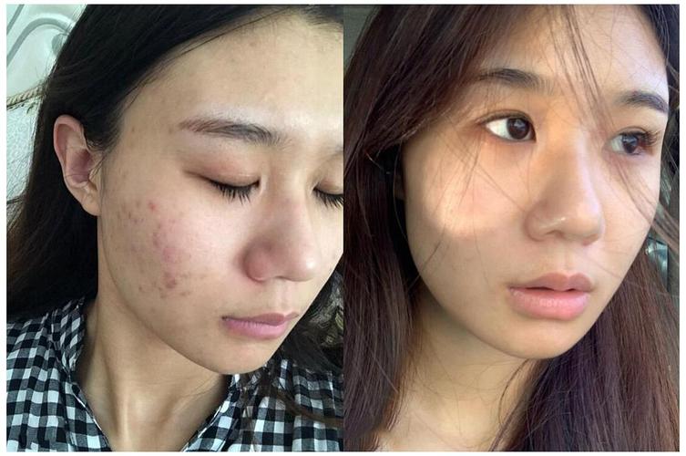 祛痘亲身经历,2年祛痘成功的真实经历告诉你如何有效