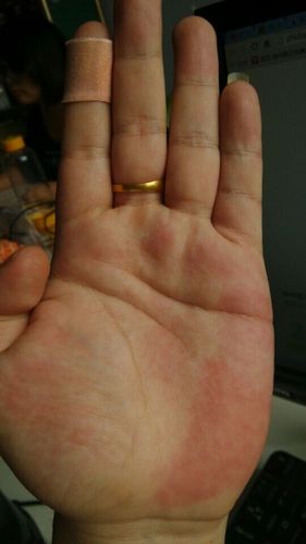 问:手掌下角那块肉 很红 请问是什么原因呢?有段时间了!