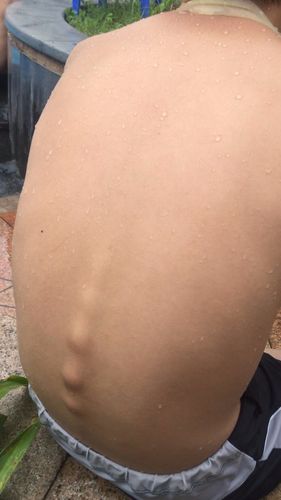 我家小孩12岁了,今天突然发现他的脊椎骨突出,并且突出的地方的皮肤都
