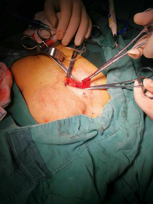 老年女性,考虑切断圆韧带并结扎